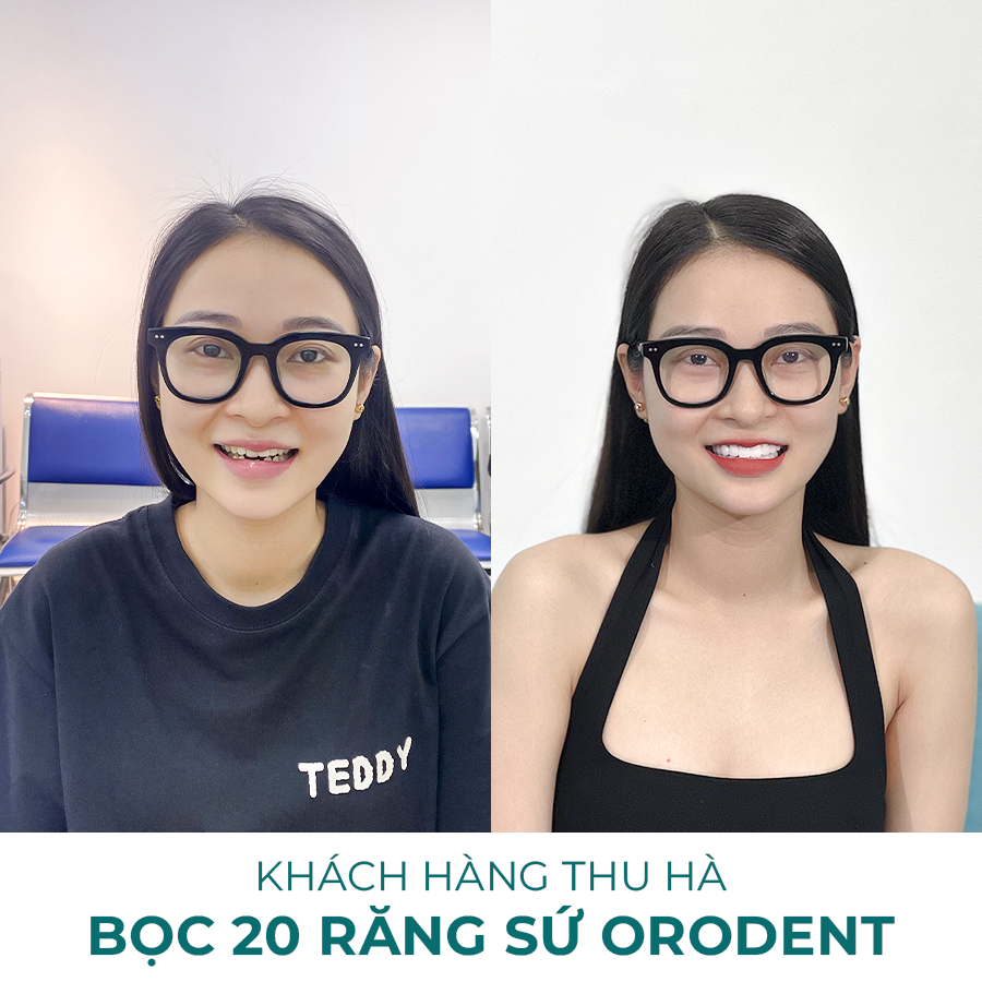 boc-rang-su-loai-nao-thi-tot