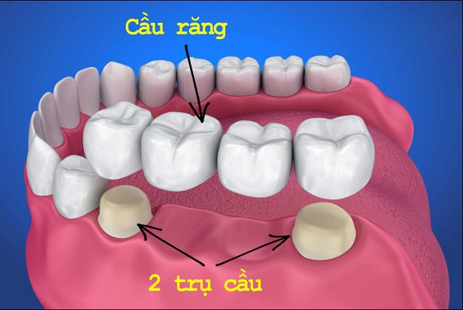 boc-rang-su-dinh-lien-co-tot-khong